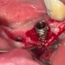 새이처럼치과의원 | [아산 연세원치과]실패한 임플란트의 재건: 주변 뼈 손상을 최소화하는 정밀 제거와 재식립 기술