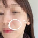 드올의원 | 인생 첫 레이저 슈링크유니버스300샷 일주일 (feat.드올의원)