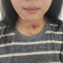 3 | 대구 반월당 얼굴 이중턱람스 당일부터 3개월 후기