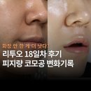 18 | 리투오 18일차 후기 ㅣ 코모공 피지량 줄어들까?(+모공, 피부결, 각질 변화)