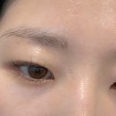 손톱이야기 | 신논현성형외과 흉터제거 오래된 손톱흉터 큐어젯 후기
