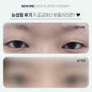 뉴원성형외과의원 | 부산성형 눈성형후기 생생한 결과를 확인해요