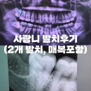 진교정치과의원 | [치과] 강남레옹치과_사랑니 2개 발치 후기 (매복O)