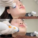 보민약국 | 고주파리프팅 텐써마 300샷 시술 전, 후 비교 리얼 후기 / 언주역 피부과 돌싱글즈6 보민