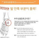 혹시 복사뼈밑에 뼈가 하나 더 튀어나와있어? 그거슨 -부주상골 증후군 이미지