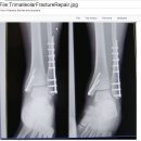 Trimalleolar Fx --＞ ORIF & cannulate screw & tubular plate 이미지