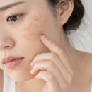 빌리브피부과의원 | 수성구피부과, 레이저토닝 몇 회 받아야 변화가 느껴질까?