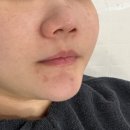 남외 | 울산 올가드림뷰티 남외점 모공디톡스 후기