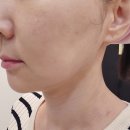 타임 | 인천구월동 피부과 - 이중턱에 튠라이너20kj 효과, 통증, 다운타임 후기