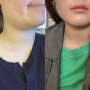 브이올렛 주사로 이중턱 조지기, 붓기/멍 후기, 마기꾼 탈출?