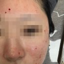 오모드 | 밴스의원 홍대, 포텐자니들 모공 모드 후기, 내돈내산, 일주일 후 후기