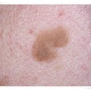 앤블랑의원 | 안양 피부과 추천, 잡티제거 부작용 줄이려면?