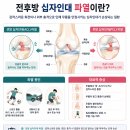 은십자 | 전방십자인대 파열 : 증상 및 재건술 후기 총정리 (급성 파열, ACL 재건술, 재활)