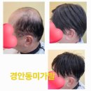 뷰티건강샾 | 경기 광주 남자 맞춤가발 잘하는샾 (경안동미가발) 리얼후기 ~