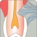 치아교모증,치아마모증,이갈이,악물기,잘못된 칫솔질,치경부마모증,레진치료 이미지