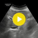 담낭 절제술후 간내담관,간외담관 확장(dilated CBD and IHD after cholecystectomy) 이미지