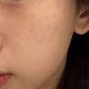 (주)바이온 | [듀얼토닝 4회차] 레이저토닝 + 엑셀브이 + 백옥주사 600mg 후기 l 안산 데이즈 피부과ㅣ내돈내산