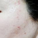 이종호 | 피부과 점빼기 한달 후기 주의사항 이종호피부과