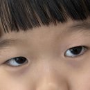 서론 | 유아 안검내반 수술 후기 / 눈물샘막힘 튜브삽입수술 후기 1(서론)