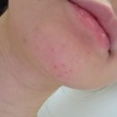 네일티크 광주상무본점 | 광주 피부관리 쌍촌동 피지쏙쏙 상무지구 임산부 여드름압출