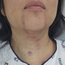 다빈치덴탈 | 조대병원 갑상선암 5단계 로봇수술준비물과 후기