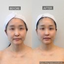 윈메디칼 | 김천율곡동피부관리 뷰티아늑에서 쌍둥이맘의 얼굴선 안색 되찾기