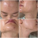 예스필의원 | 겨울철 갑자기 번진 여드름 관리 후기｜필링 1회 + 항생제 5일 경과 &amp; 색소침착 고민