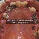 정석외과의원 | [광명 전체임플란트] 구강외과전문의 꼭 필요한 개수로 식립 한 전체 임플란트 과정 기록