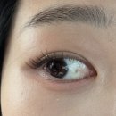 리더스서울안과의원 | [방배] 리더스성모안과 연예인도 한다는 결막모반 제거 후기!! (결막모반 제거 잘하는곳, 방배동 안과...