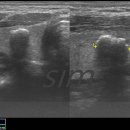 Peripheral Calcification in Thyroid Nodule 이미지