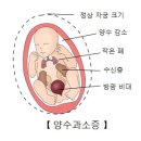 양수과소증[Oligohydramnios] 이미지