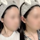 강남-291 | 강남구청역 헤어라인 SMP 시술 후기 | 두피SMP 잘하는 피씨엘코리아(PCL KOREA) 추천