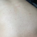 진메디칼솔루션 | 대구 등드름 관리 솔에스테틱 대구점 바디리셋솔루션케어 2회 패키지 후기 | 대구 중구 “솔에스테틱”