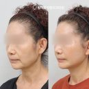 빌리프성형외과의원 | 안면거상후기를 통한 안면거상술 후 실제 변화