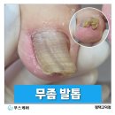 다해메디칼 | 평택고덕 무좀발톱, 두꺼워진 발톱 관리 사례(60대 남성 후기)