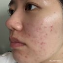 필의원 | [내돈내산] 홍대 제이필의원 여드름 치료 – 아그네스 &amp; 제스너필 후기