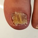 페디베네 | 구미에서의 무좀발톱 관리, 진평동과 인동 근처 당신의네일 페디베네 구미점에서의 최적의 선택지