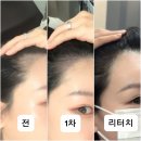 라인 | [신촌smp] 모비디크뷰티 헤어라인 대만족 후기｜통증, 비포애프터, 리터치 총정리
