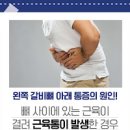 왼쪽 갈비뼈 통증 갈비뼈금통증 갈비뼈 골절 증상 이미지