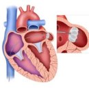 애보트메디칼코리아 유한회사 | 국제적 신뢰 높은 “LAAO” 선별급여 재평가 개선 필요