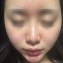 (주)하나메디랩 | 가정용 LDM 디바이스 뭐 사야할까 고민중 ㅣ 쿼드쎄라, UDM , 글로우엠 , 톰더글로우