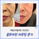 대신의원 | 신논현피부과 예쁨주의쁨의원 강남본점에서 울쎄라 대신 울트라인 리프팅한 후기