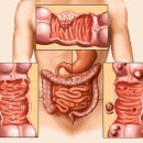 변비와 비슷한 대장암증상 이미지