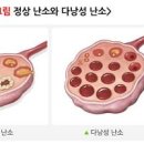 다낭성 난소 증후군 원인 증상 치료 이노시톨 효능 부작용 이미지