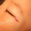 대구종합약국 | 대구 아이얼굴 상처 달서구 아무르성형외과에서 치료받은 봉합 후기
