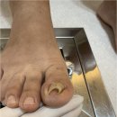 동성메디칼 | 군포내성발톱 강추하는 곳 풋네일 동성제약 풀리메디 군포산본점