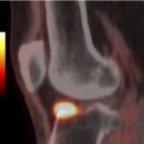 골거대세포종 [ giant cell tumor of bone, Riesenzellengeschwulst des Knochens ] 이미지