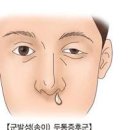 군발성 두통 원인 증상 치료 이미지