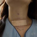 김호수 | 갑상선암 진단 후기, 초기증상 및 원인 (feat.베네스다시스템)