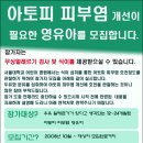 서울대 영유아 아토피 개선 참가자 모집(무료 알레르기 검사) 이미지